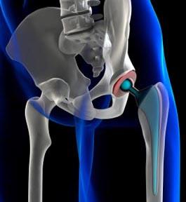 Hip Replacement Coatings 