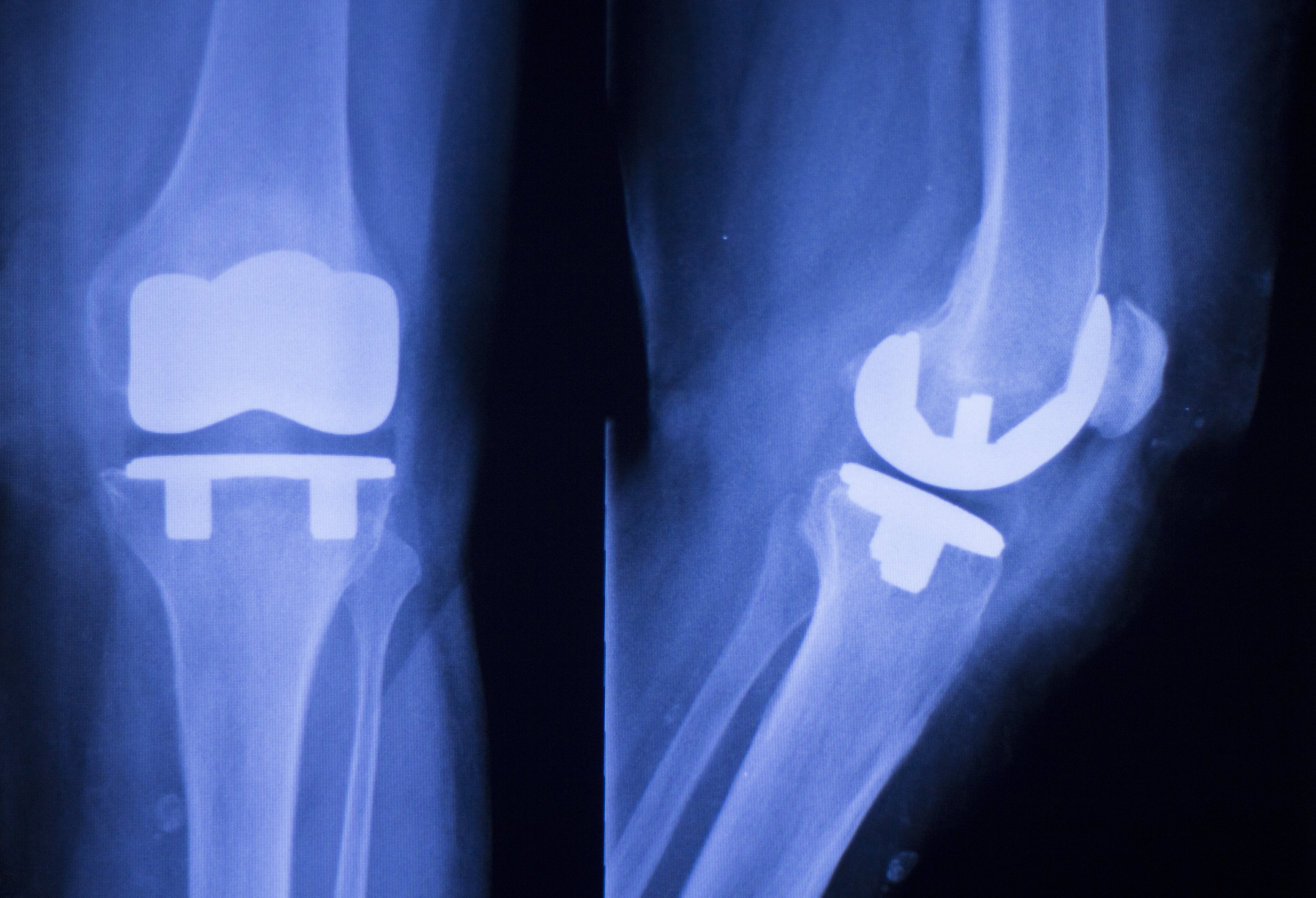 knee joint implant